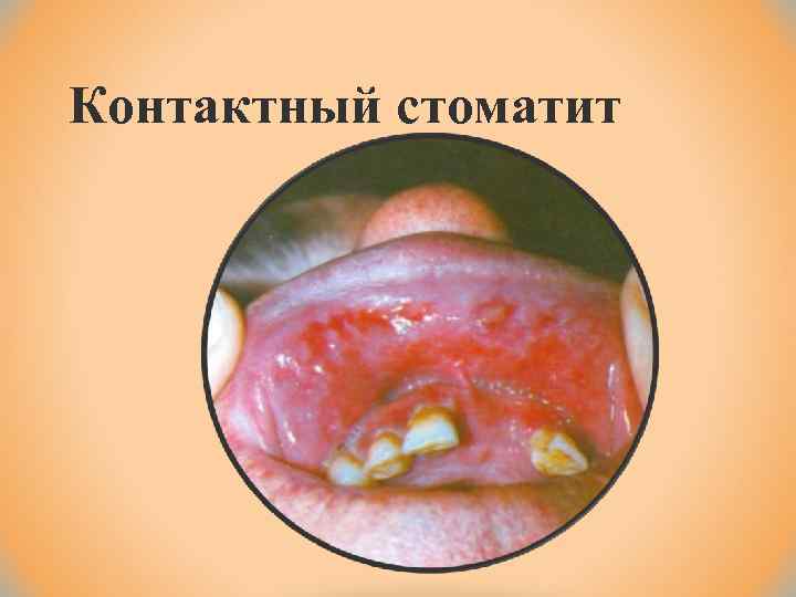 Контактный стоматит 
