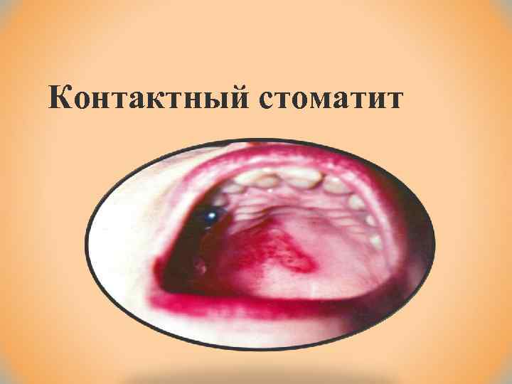 Контактный стоматит 