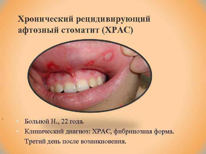 Хронический рецидивирующий афтозный стоматит (ХРАС) . § Больной Н. , 22 года. § Клинический