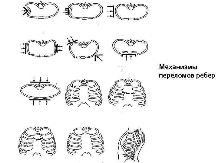 Механизмы переломов ребер 