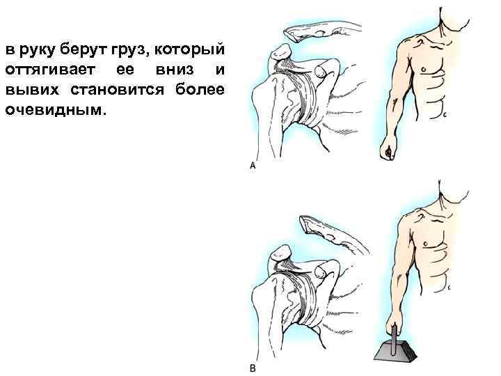 в руку берут груз, который оттягивает ее вниз и вывих становится более очевидным. 