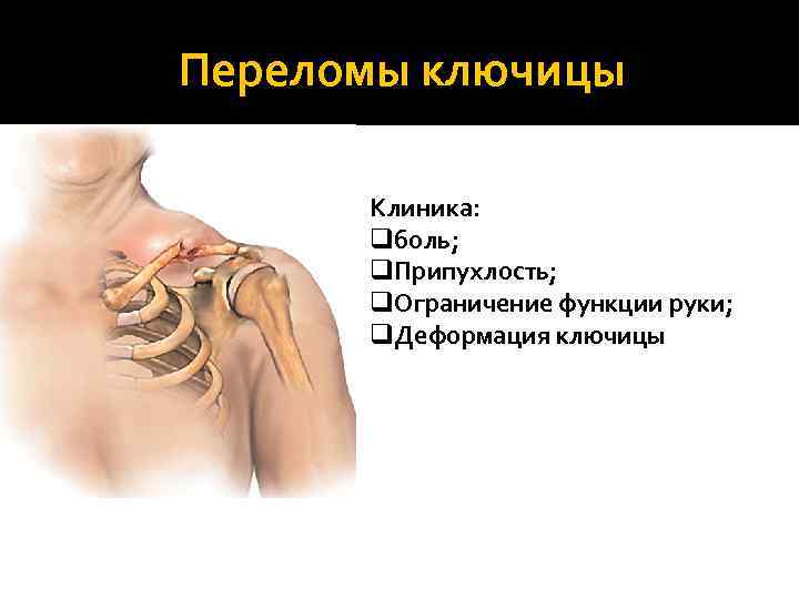 Переломы ключицы Клиника: qболь; q. Припухлость; q. Ограничение функции руки; q. Деформация ключицы 