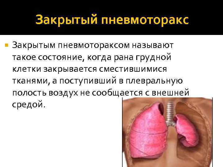 Закрытый пневмоторакс Закрытым пневмотораксом называют такое состояние, когда рана грудной клетки закрывается сместившимися тканями,
