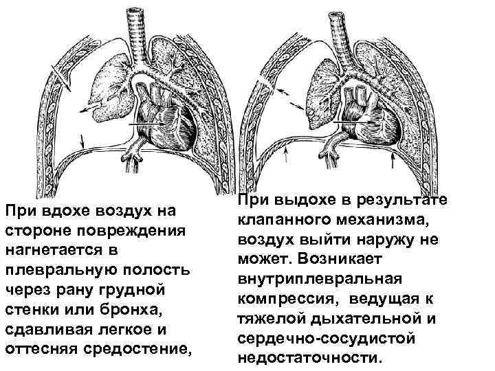 Какое значение имеет герметичность стенок грудной полости в механизме вдоха