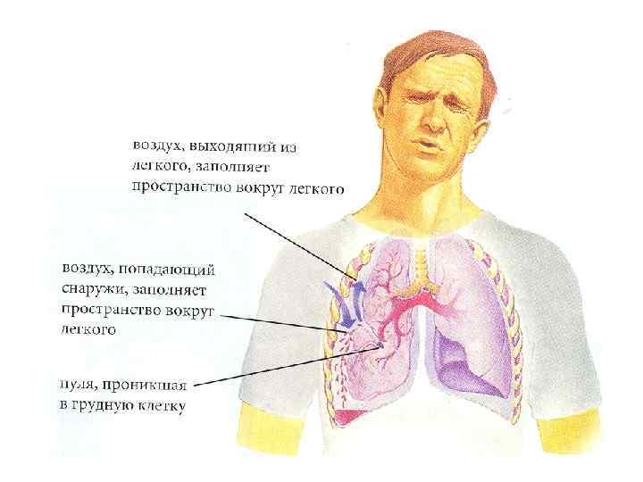 Признаки ранения грудной клетки