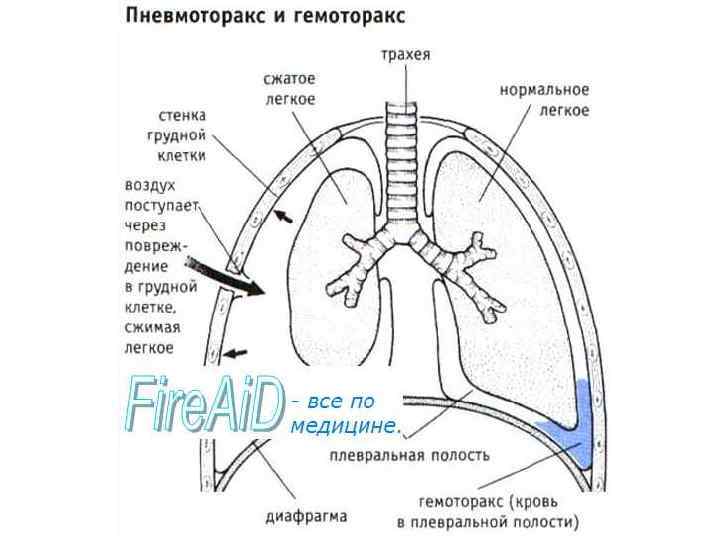 Пневмоторакс легких что это