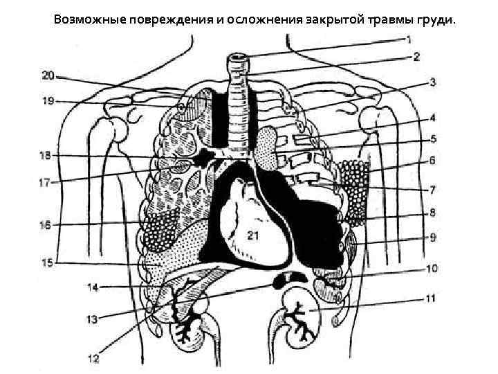 Возможные повреждения и осложнения закрытой травмы груди. 