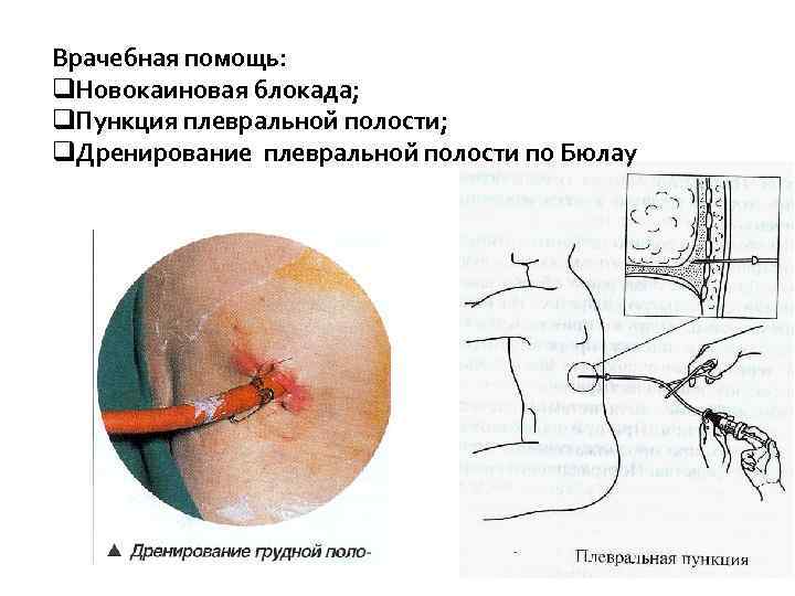Врачебная помощь: q. Новокаиновая блокада; q. Пункция плевральной полости; q. Дренирование плевральной полости по
