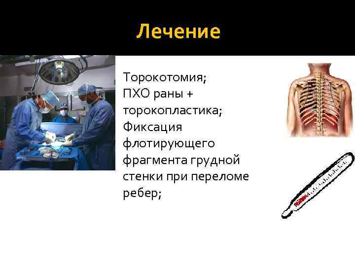 Лечение Торокотомия; ПХО раны + торокопластика; Фиксация флотирующего фрагмента грудной стенки при переломе ребер;