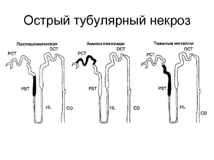 Острый тубулярный некроз 