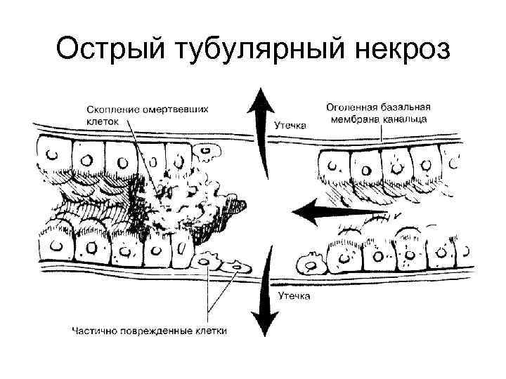 Острый тубулярный некроз 