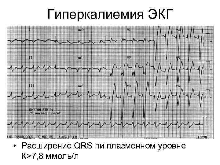 Гиперкалиемия ЭКГ • Расширение QRS пи плазменном уровне К˃7, 8 ммоль/л 