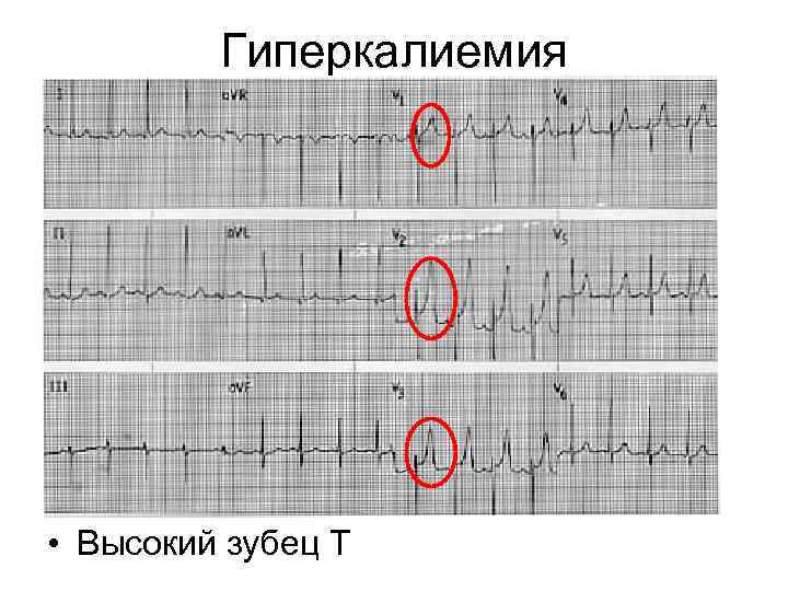 Гиперкалиемия • Высокий зубец Т 