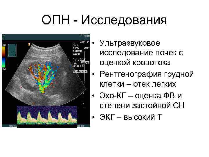 ОПН - Исследования • Ультразвуковое исследование почек с оценкой кровотока • Рентгенография грудной клетки