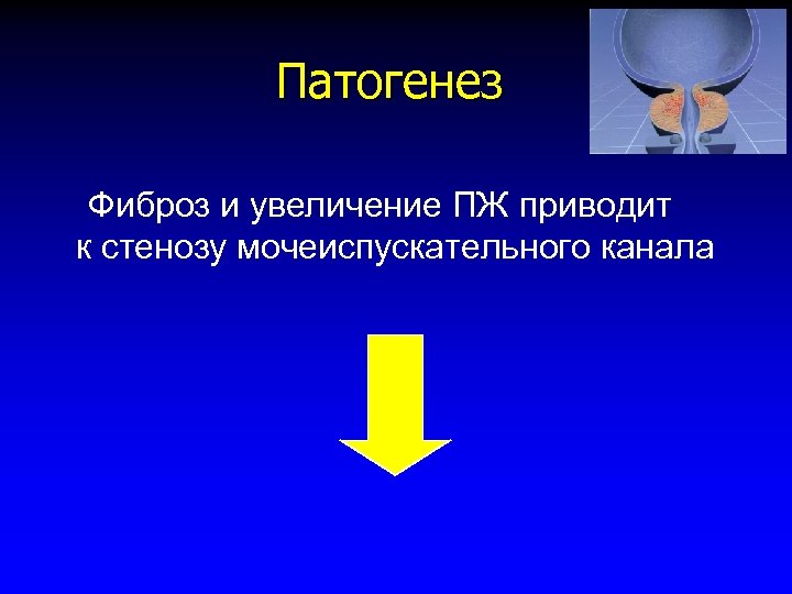 Патогенез Фиброз и увеличение ПЖ приводит к стенозу мочеиспускательного канала 