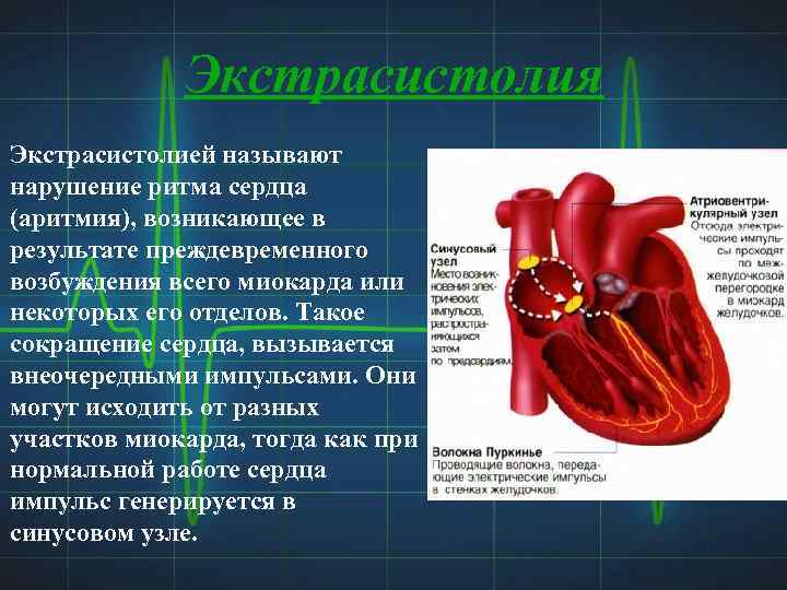 Нарушение экстрасистолы. Желудочковая аритмия сердца. Экстрасистолия сердца. Желудочковая экстрасистолическая аритмия. Нарушение ритма сердца желудочковая экстрасистолия.