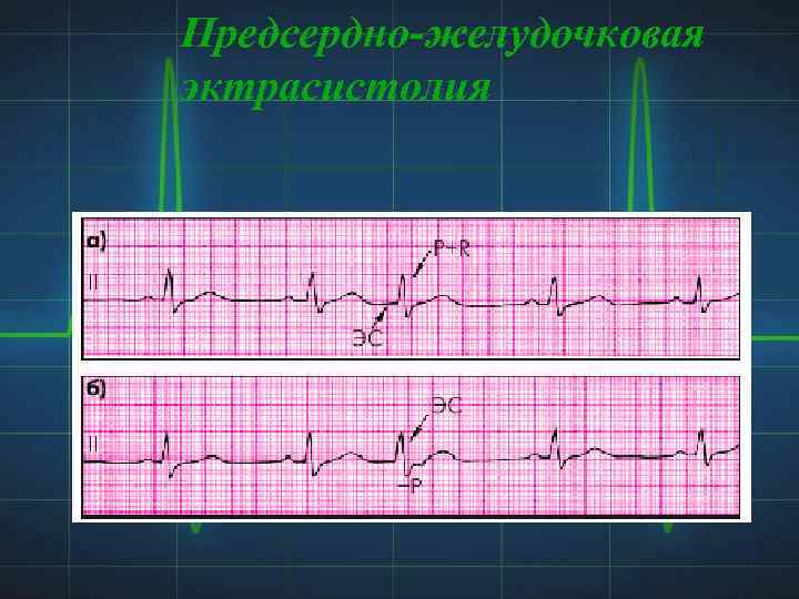 Предсердно-желудочковая эктрасистолия 