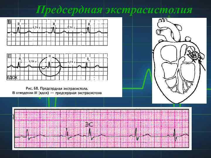 Предсердная экстрасистолия 