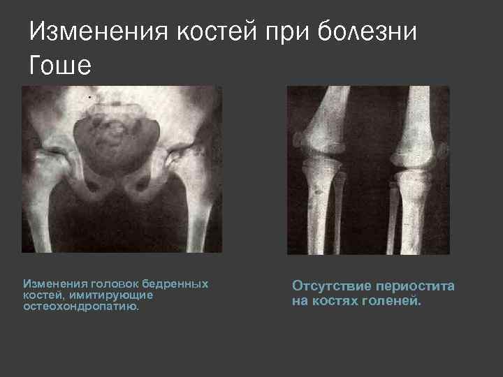 Изменения костей при болезни Гоше Изменения головок бедренных костей, имитирующие остеохондропатию. Отсутствие периостита на