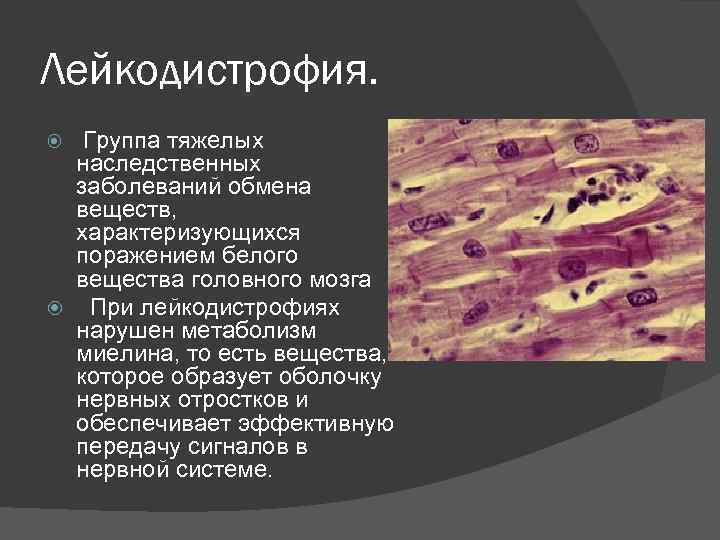 Лейкодистрофия. Группа тяжелых наследственных заболеваний обмена веществ, характеризующихся поражением белого вещества головного мозга При