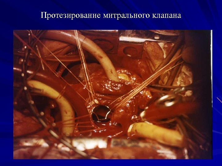 Протезирование митрального клапана 