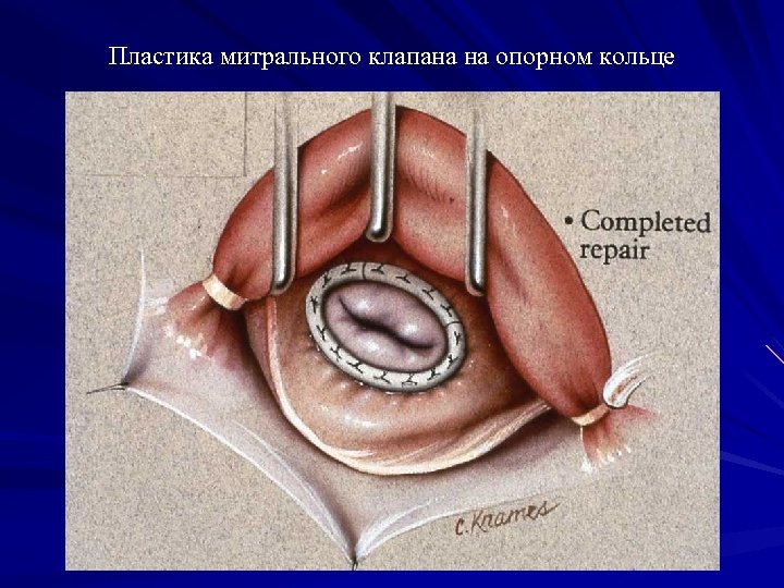 Пластика митрального клапана на опорном кольце 