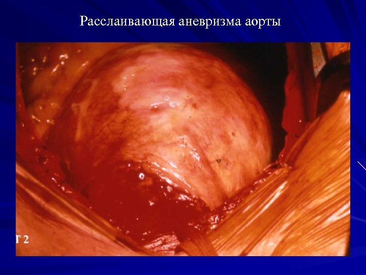 Расслаивающая аневризма аорты 