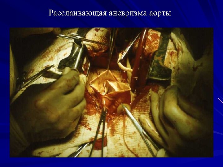 Расслаивающая аневризма аорты 