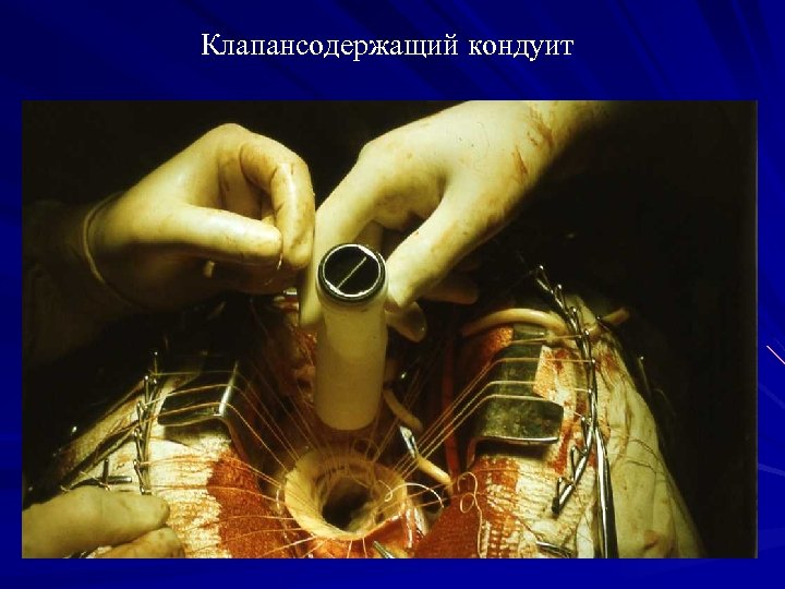 Клапансодержащий кондуит 