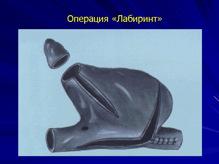 Операция «Лабиринт» 