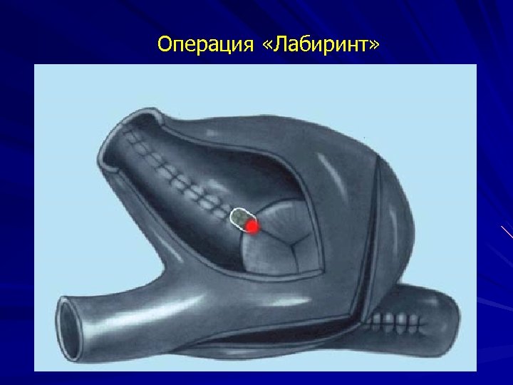 Операция «Лабиринт» 