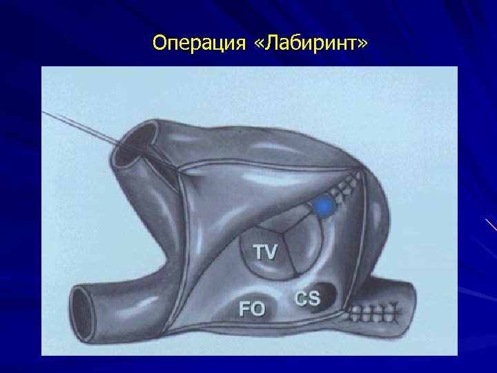 Операция «Лабиринт» 