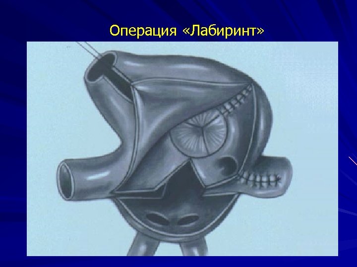 Операция «Лабиринт» 