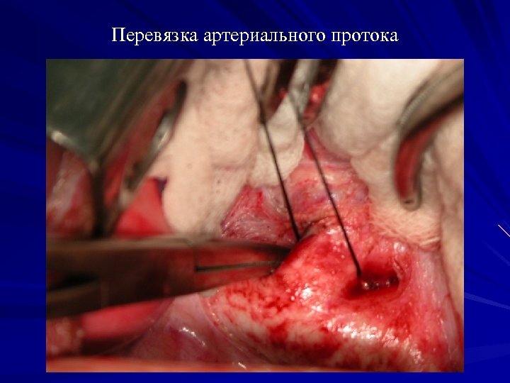 Перевязка артериального протока 