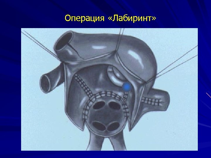 Операция «Лабиринт» 