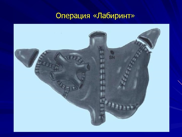 Операция «Лабиринт» 