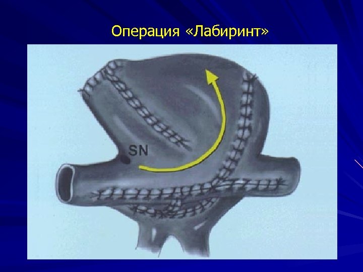 Операция «Лабиринт» 