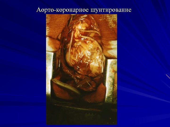 Аорто-коронарное шунтирование 