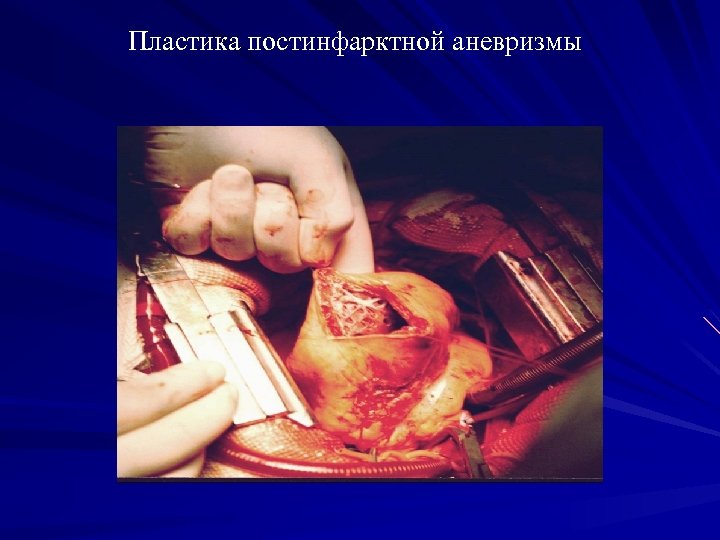 Пластика постинфарктной аневризмы 