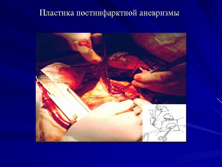 Пластика постинфарктной аневризмы 