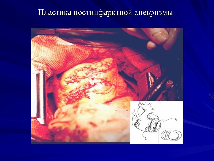 Пластика постинфарктной аневризмы 