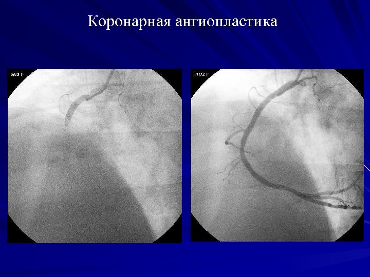Коронарная ангиопластика 