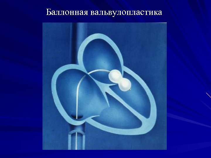 Баллонная вальвулопластика 