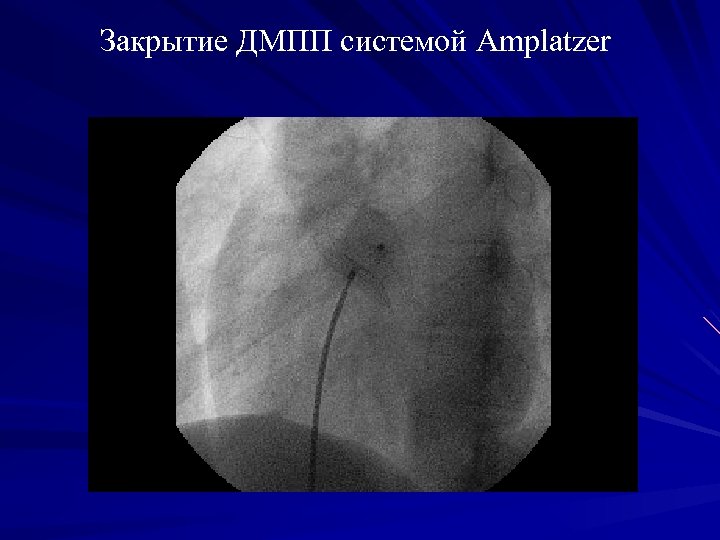Закрытие ДМПП системой Amplatzer 