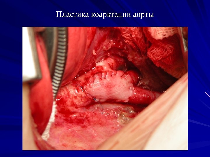 Пластика коарктации аорты 