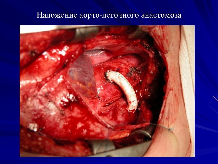 Наложение аорто-легочного анастомоза 
