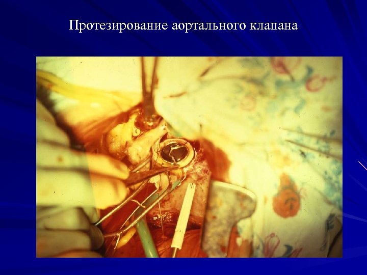 Протезирование аортального клапана 