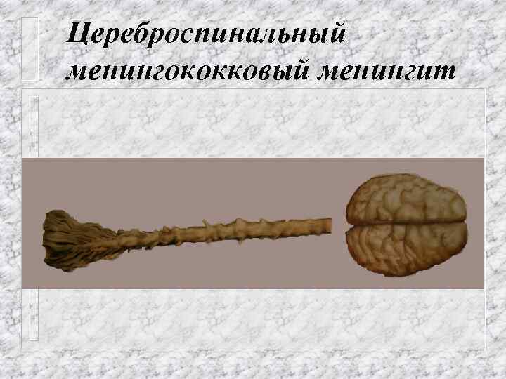 Цереброспинальный менингококковый менингит 