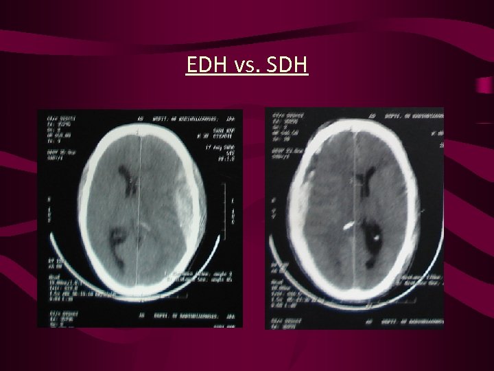 EDH vs. SDH 