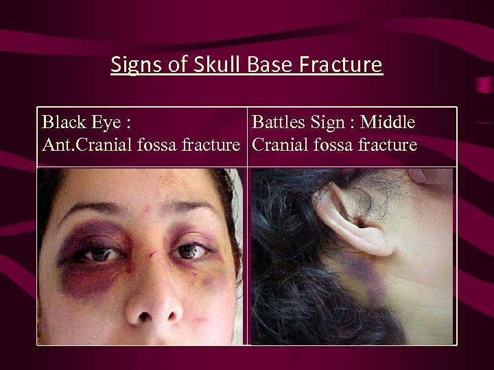 Signs of Skull Base Fracture Black Eye : Battles Sign : Middle Ant. Cranial